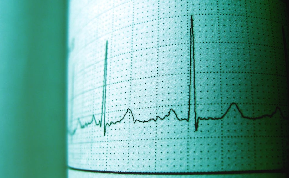 早搏监测：守护心脏健康的精准利器